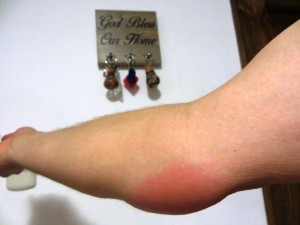 Gestoken door insect